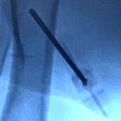 Outdated Bone Marrow Harvesting Procedure